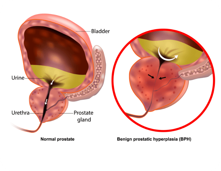 Benign Prostatic Hyperplasia