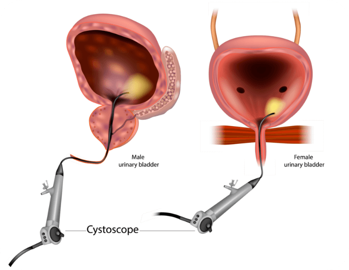 Cysyoscopy Urodunamic