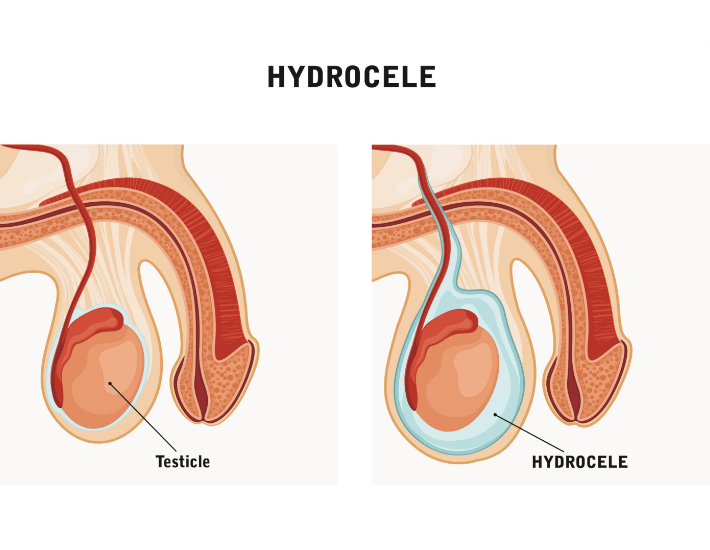 Hydrocele