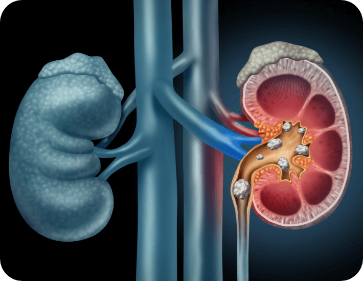 Kidney Stones