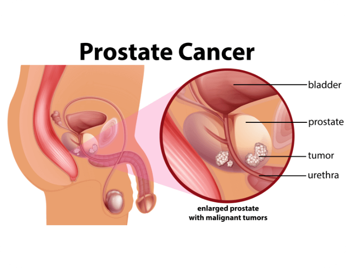 Prostate Cancer