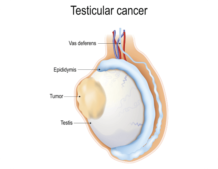 Testicular Cancer