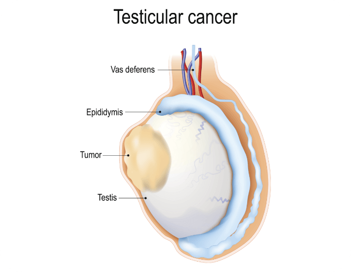 Diagnosing Testicular Cancer How To Diagnose Testicular Cancer AEQM Diagnosing Testicular Cancer How To Diagnose Testicular Cancer AEQM
