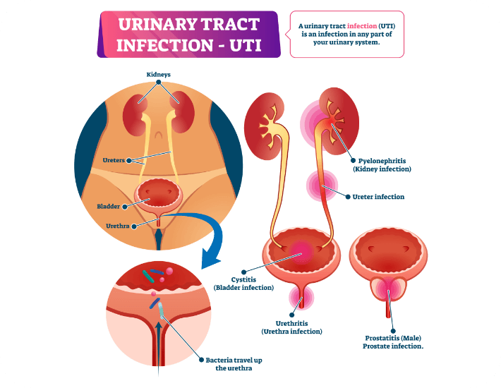 UTI